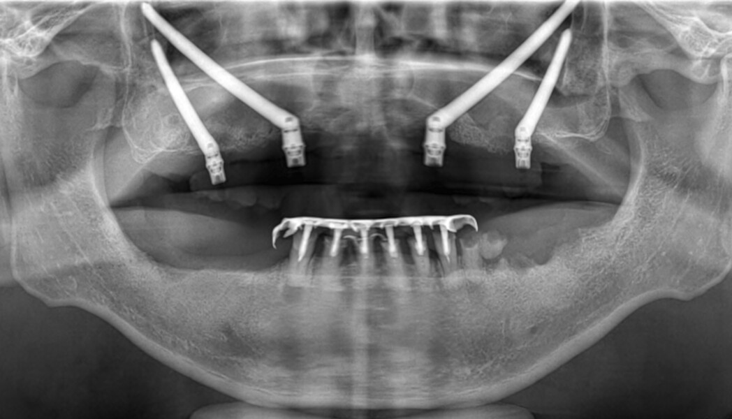 Fig. 4: Postoperative panoramic radiograph showing the four zygomatic implants.