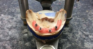 Rekonstrukcja implantoprotetyczna bezzębnej żuchwy