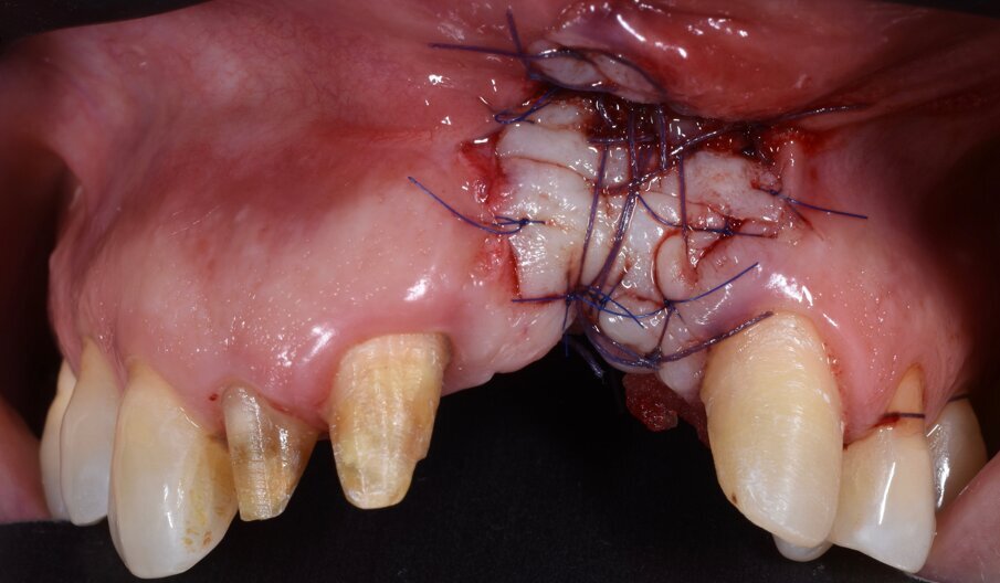 Fig. 8 - Innesto di epitelio connettivale libero dopo 4 mesi dalla guarigione del sito implantare.