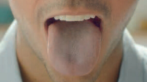 Causes et traitement de l’halitose