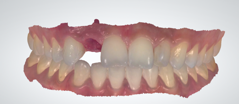 Fig. 15 - Impronta digitale superiore ed inferiore.