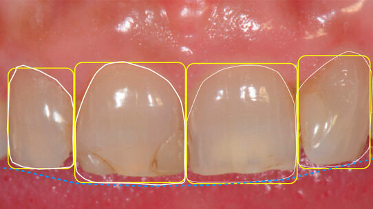 La programmazione  del ringiovanimento  del sorriso