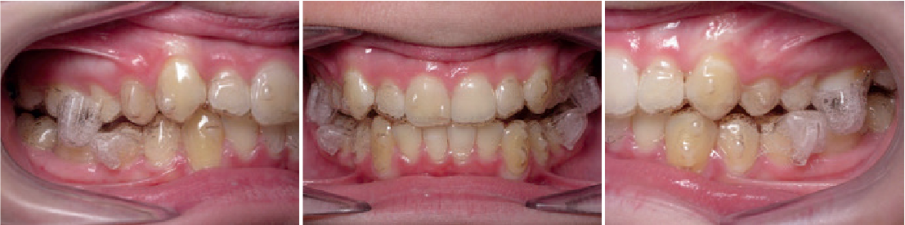 Intraoral view of Invisalign treatment with mandibular advancement