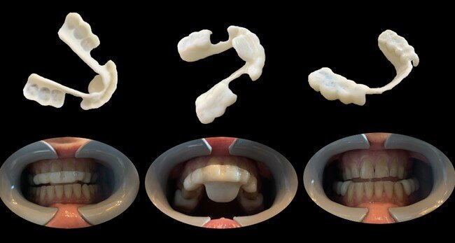 Fig. 13_I dispositivi stampati digitalmente, privi di parti metalliche, realizzati per le arcate inferiore e superiore in base alla posizione terapeutica individuata durante la visita diagnostica. Idealmente i dispositivi possono essere progettati, disegnati digitalmente e stampati in 3D (tecnica additiva) lo stesso giorno della prima visita al paziente, con un flusso di lavoro one-day completamente digitale.