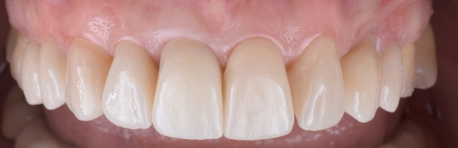 Fig. 19: Final result: partial lithium disilicate restorations on teeth #15, 14, 13, 21, 23, 24 and 25 and complete lithium disilicate crowns on teeth #12 and 11. Dental technician Fabio Corna, Medicalab, Lallio, Italy.