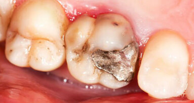 In odontoiatria niente diritto di ingresso per l’amalgama