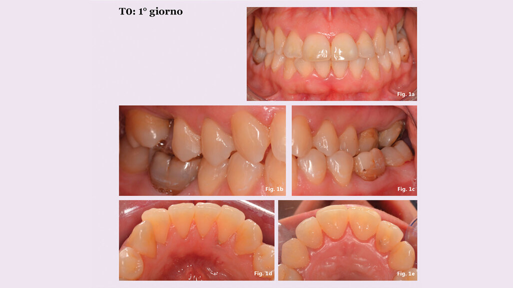 Trattamento di una Parodontite Stadio III Grado C con CHX 0,12%+CPC 0,05% e dentifricio Vitis  antistain