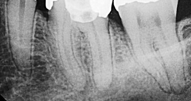 Successful single-visit molar endodontics