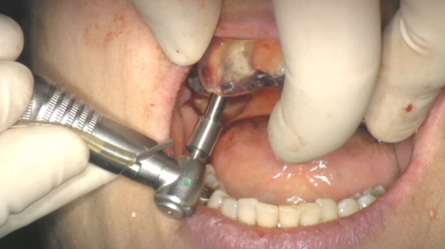 Fig. 47_Inserimento impianto.