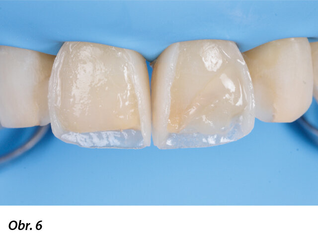 Modelace palatinálních stěn po předchozí dostavbě stěn aproximálních.