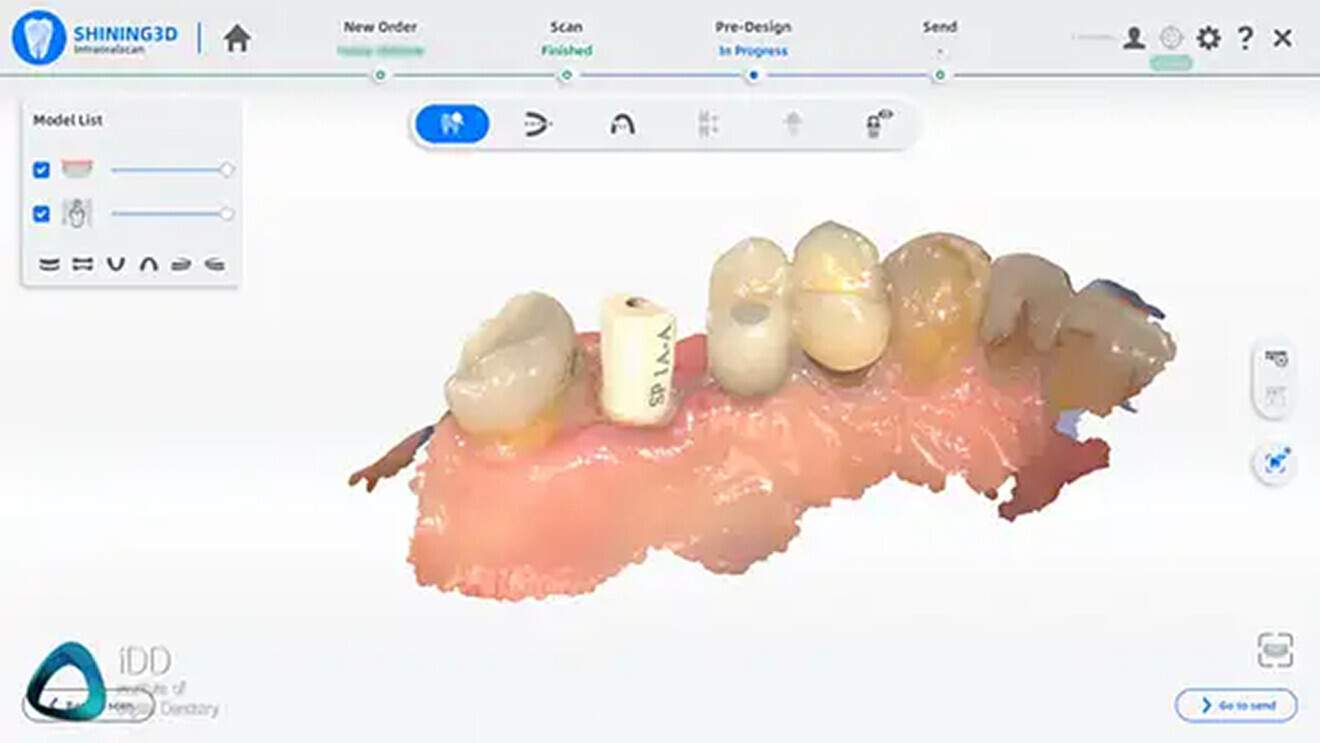 Fig. 11 & 12: Aoralscan 3 handles arches, edentulous sites and metals well.