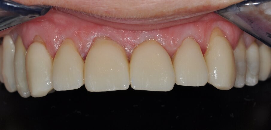 Celtra_Duo_All_Ceramic_Rehabilitation_Hausdîrfer_Riechel_Image_14_2017_07