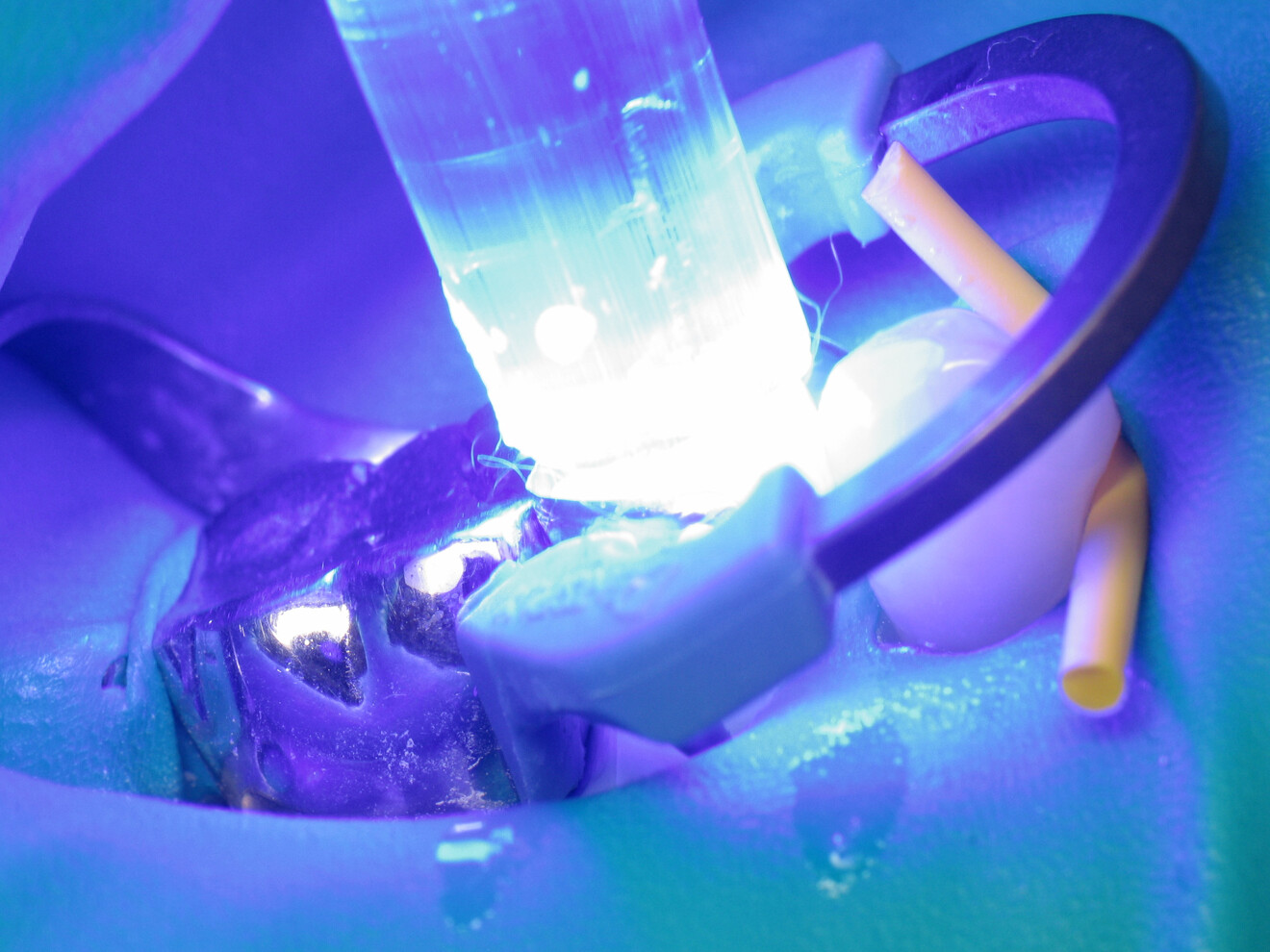 Fig. 9: Light polymerisation of the adhesive.