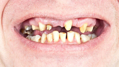 Arme Amerikanen hebben slechtere mondgezondheid