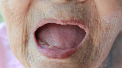 Badanie sugeruje związek przyczynowy między utratą zębów a chorobami serca