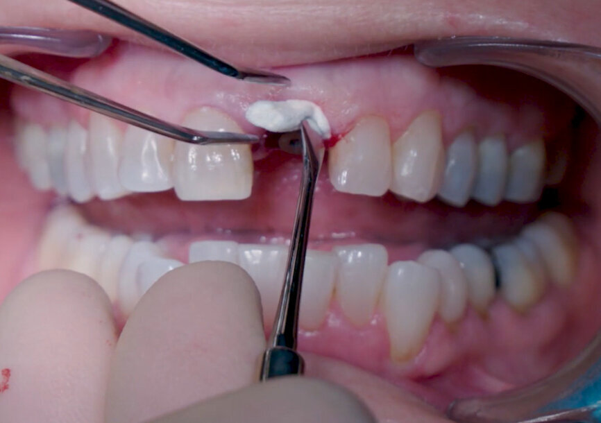 Fig. 17: Application of collacone (botiss
biomaterials).