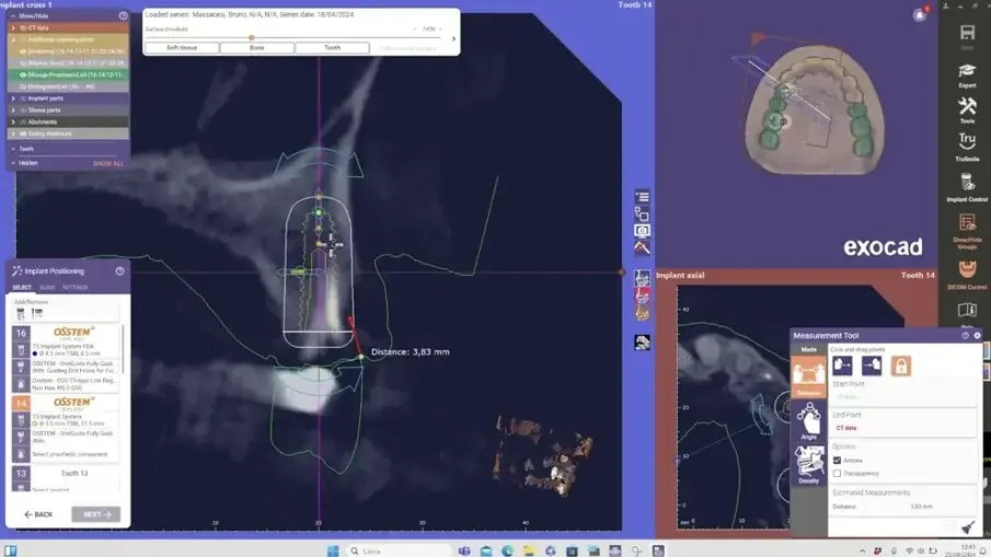Фиг. 4: Виртуално планиране на импланта на мястото непосредствено след екстракция в exoplan 3.1. 