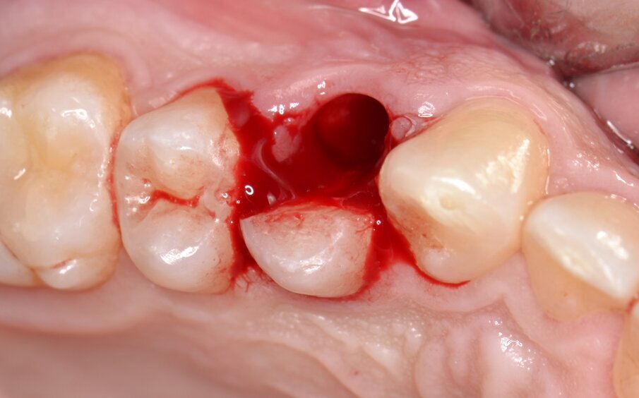 Fig. 5 - Estrazione atraumatica dell’elemento 1.4.