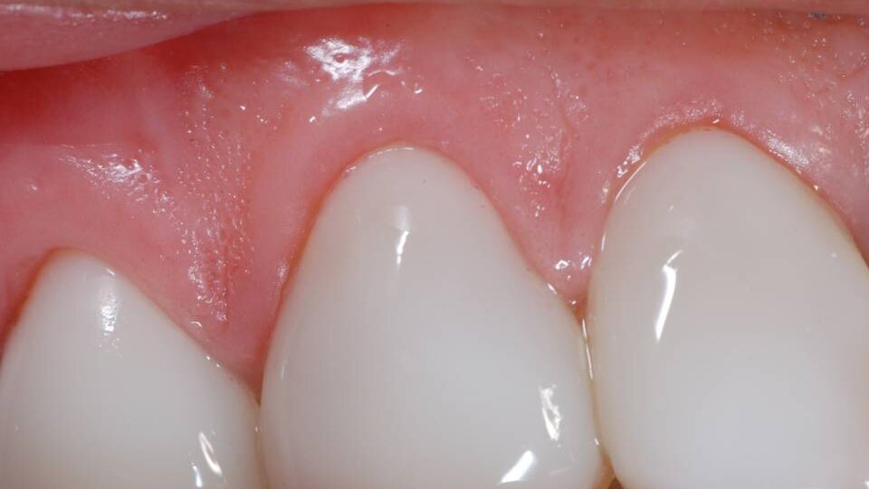 Licówki porcelanowe GlamSmile na zęby dolne i górne  Technika zakładania licówek – Część 2