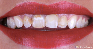 Carillas de Mínima Invasión