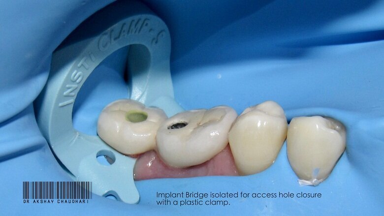 Fig - 11 Clamp on Prsothesis