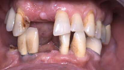 Huit implants pour un sourire