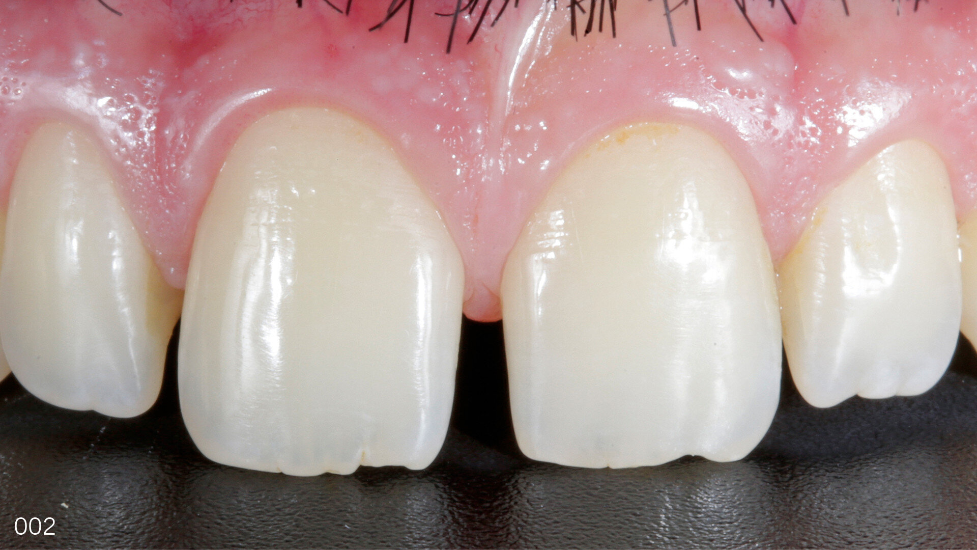 Extremely minimally invasive mock-up-guided veneer preparations in the aesthetic area