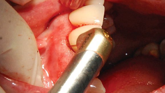 Webinar offers overview of minimally invasive periodontal laser surgery