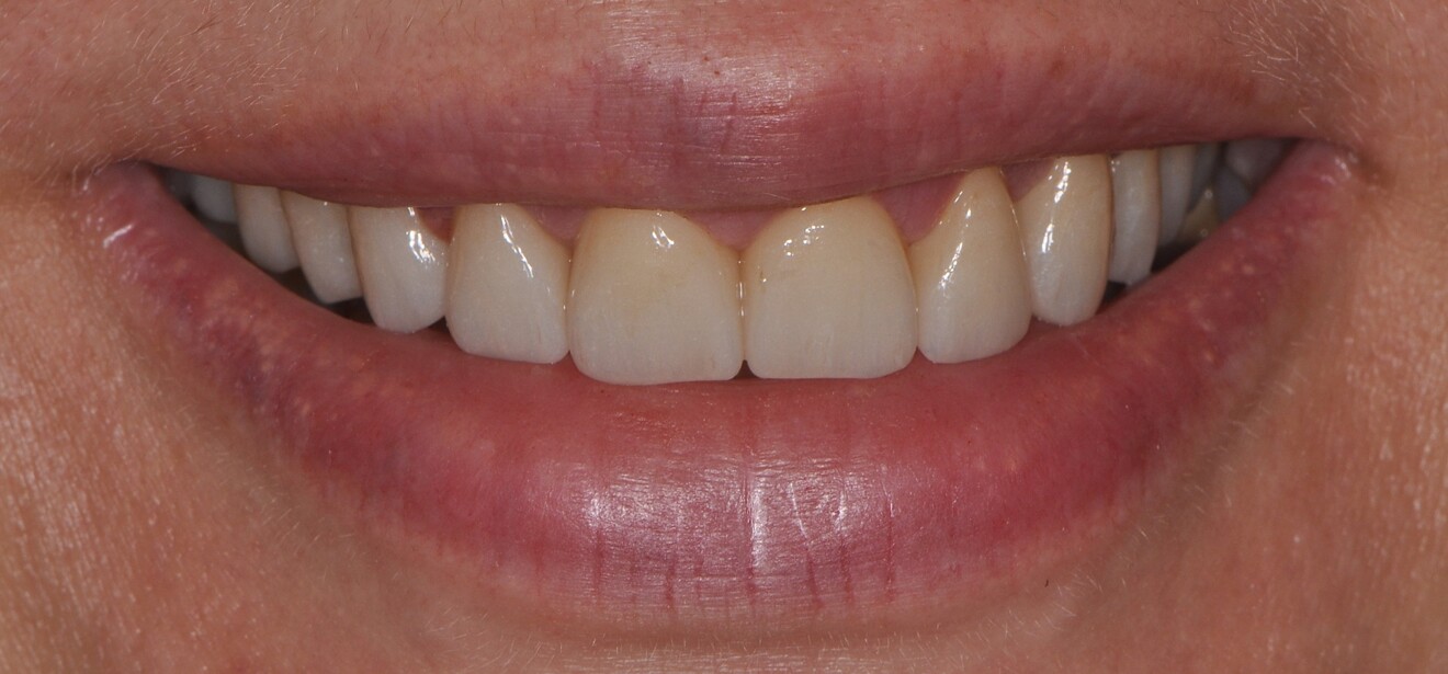Fig. 5a: Final outcome after completion of treatment. Extra-oral view showing improved aesthetics and harmonised gingival contours.
