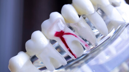 Wurzelbehandlung laut Studie besser als ihr Ruf Wurzelbehandlung laut Studie besser als ihr Ruf