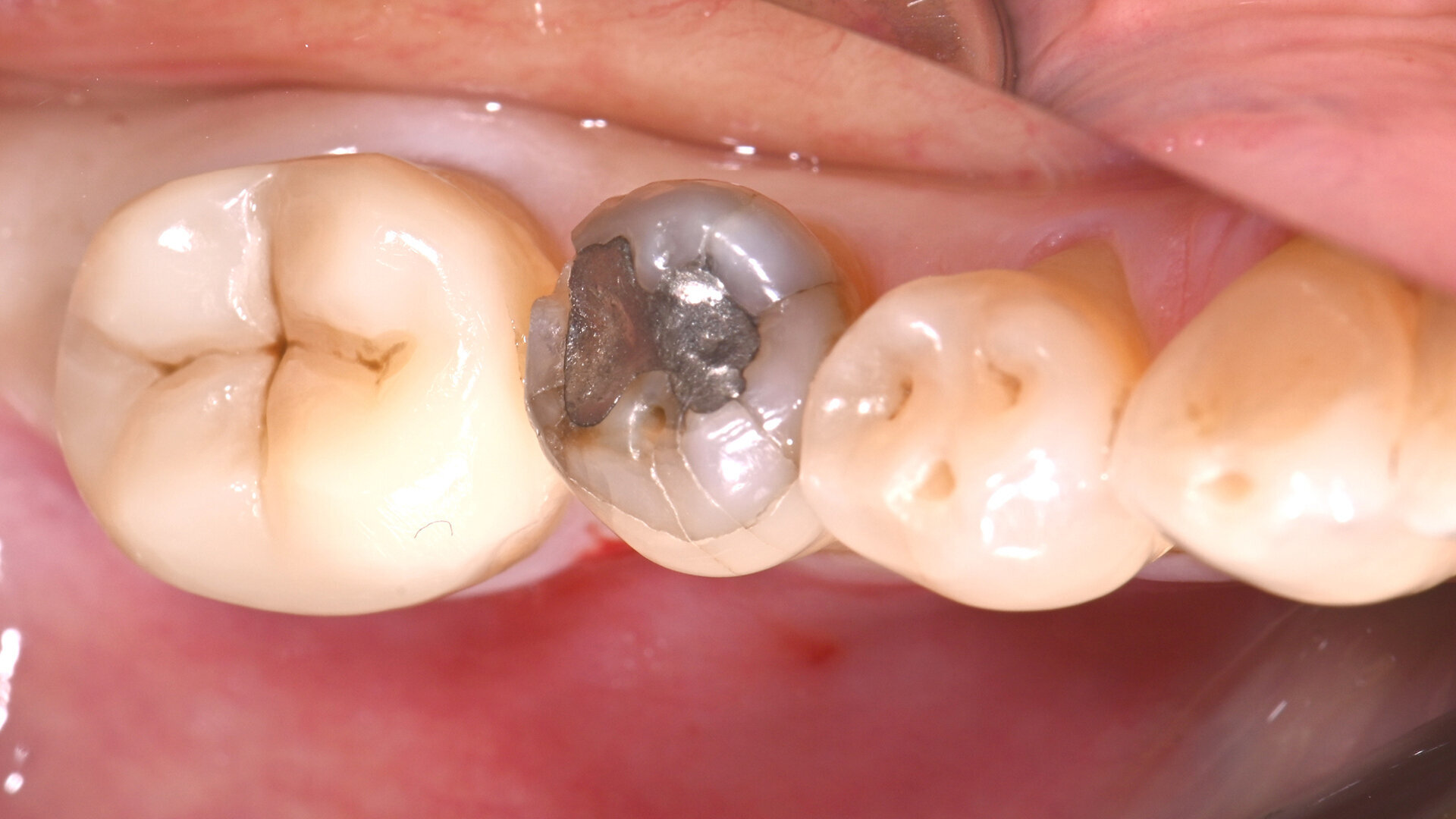 Amalgam replacement: When and why are hybrid ceramics a great option?