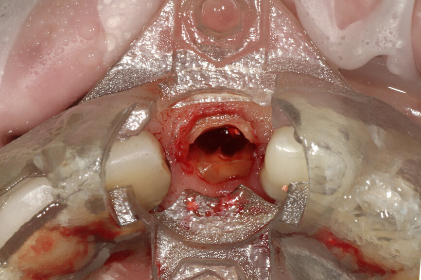 Fig. 19b: The second metal cylinder insert
allowed for the long, round diamond drills to shape the root into the desired crescent shape (a). The insert was removed to access the palatal root (b).