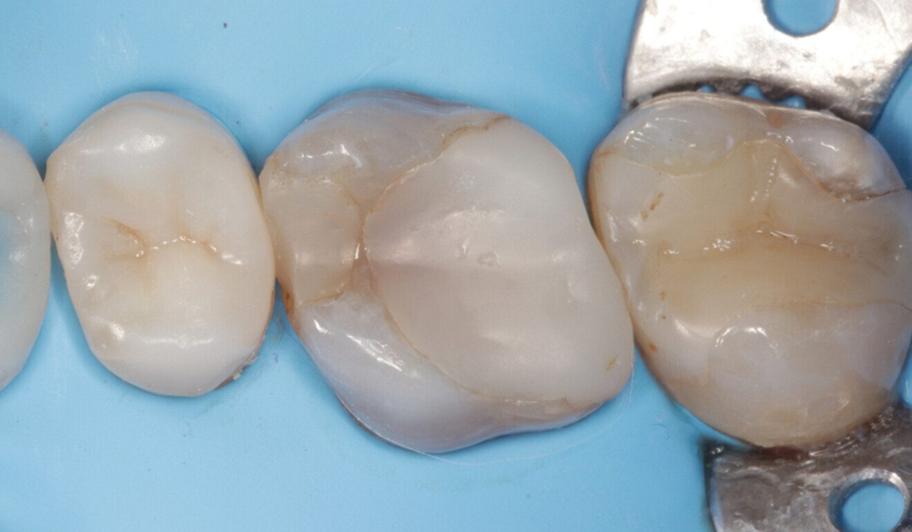 Fig. 1: Initial situation. Extensive mesio-occluso-distal composite resin restoration. (Image: Kuraray Noritake Dental)