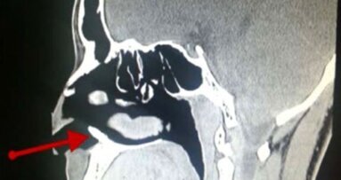 Tand groeit in neusholte