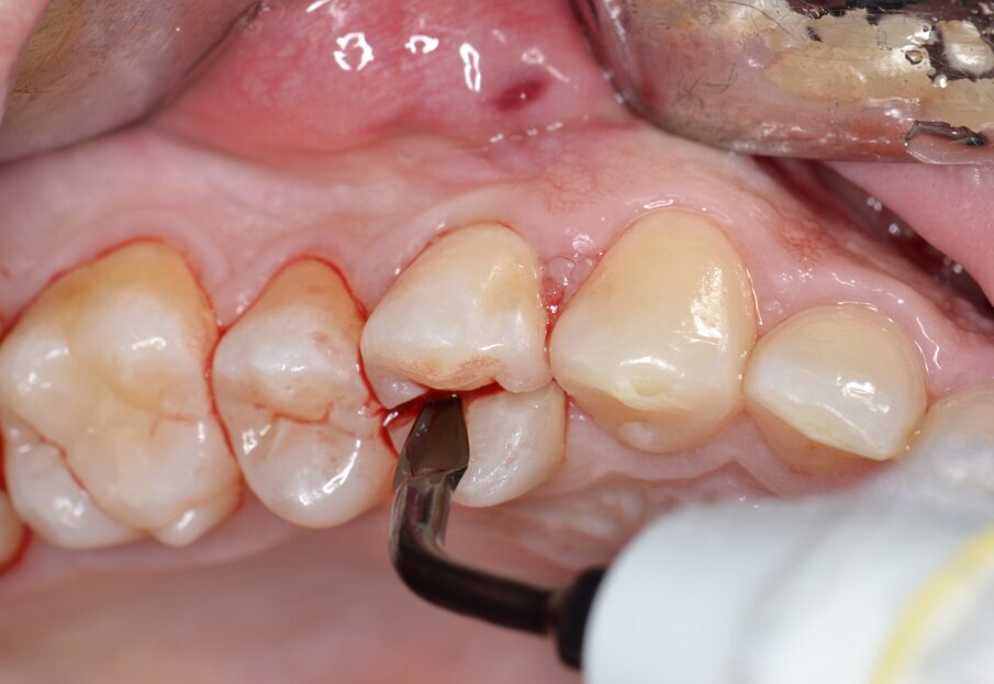 Fig. 4 - Odontotomia mediante inserto ad ultrasuoni.