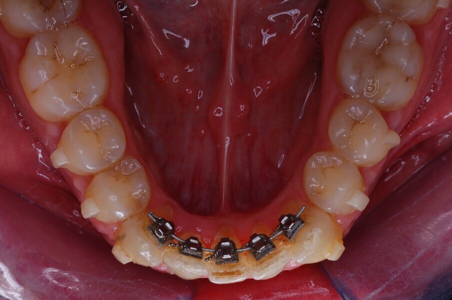 Figg. 37-44_Fotografie intraorali in sequenza che illustrano il progressivo allineamento dell’arco mandibolare.