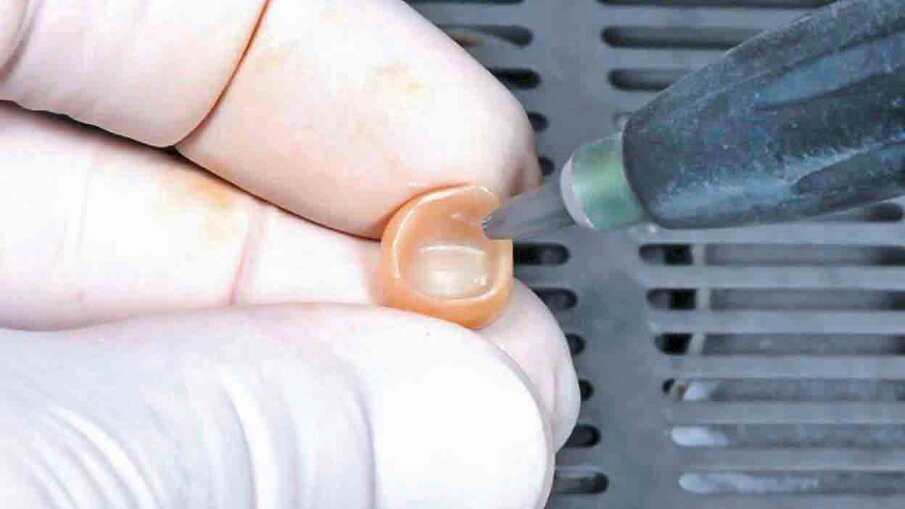 Fig. 9: Sandblasting of the crown’s intaglio surface to create a microretentive surface structure that is beneficial for cementation. This procedure is recommended for oxide ceramic materials.