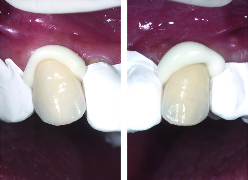 Fig. 13 : Scellement des canines supérieures avec protection en PTFE. 