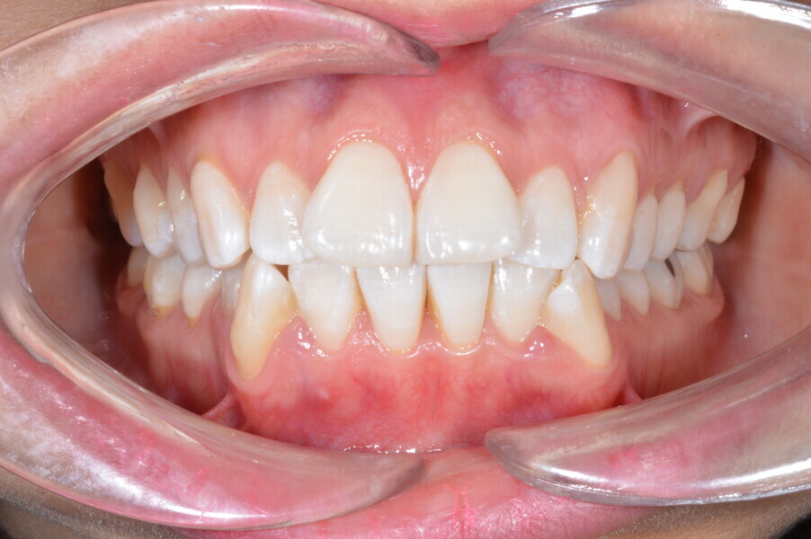 Fig. 2b: Initial intra-oral photograph.
