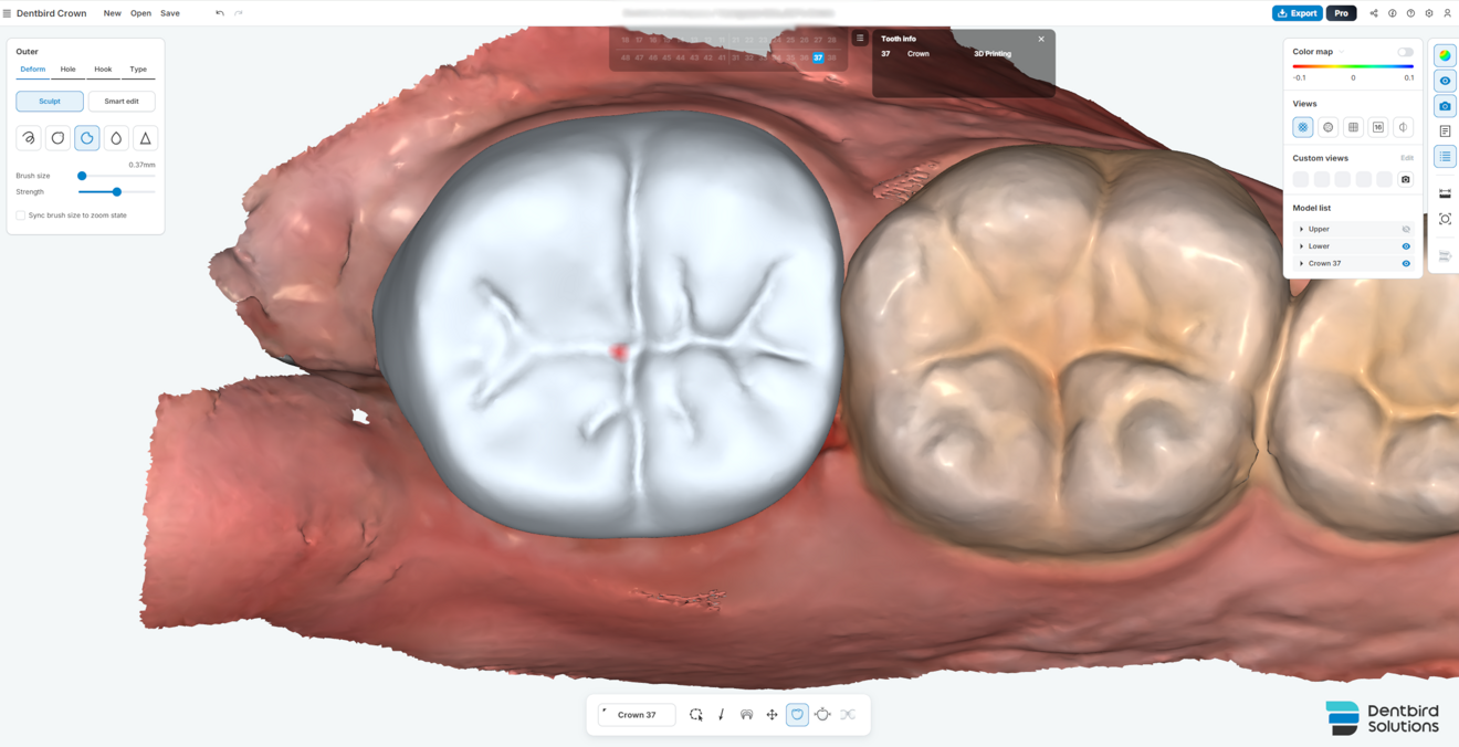 Fig. 6b: Manual refinement of the occlusal groove based on the AI-generated proposal.
