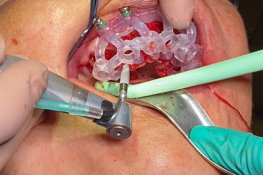 Fig. 17: Implant delivered through the guide.