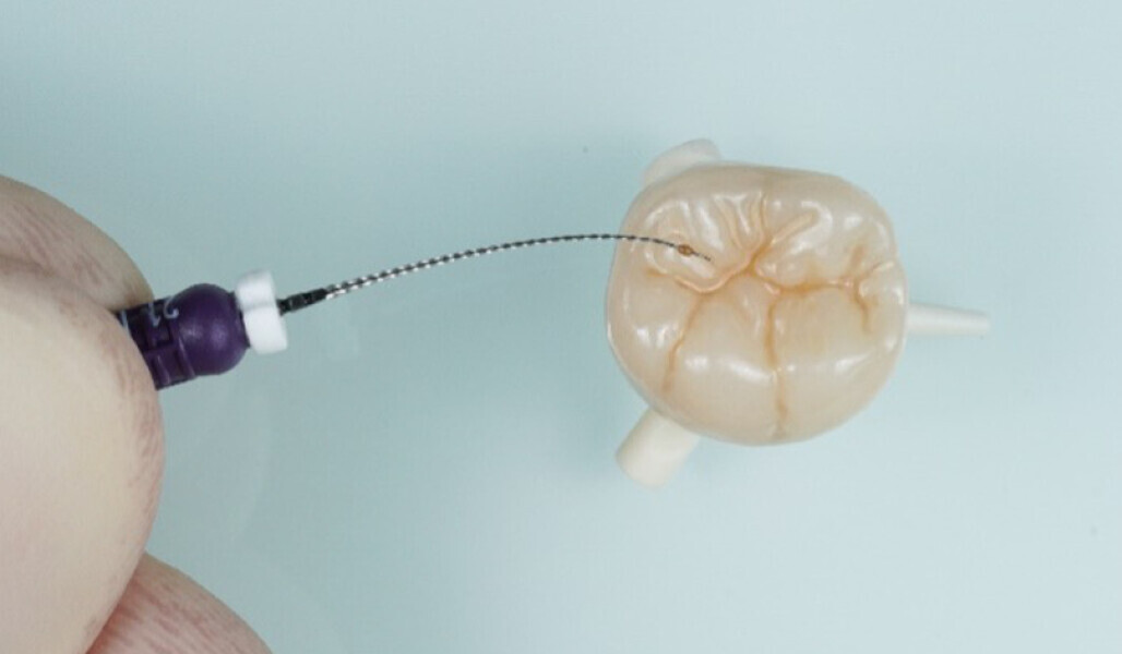 Fig. 6: Discoloured fissures being accurately replicated with an ISO size 10 endodontic file. 