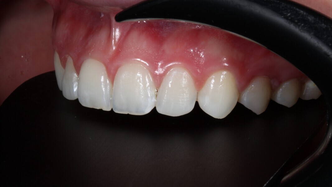 Fig. 16b: Zijaanzicht van de finale restauraties. 