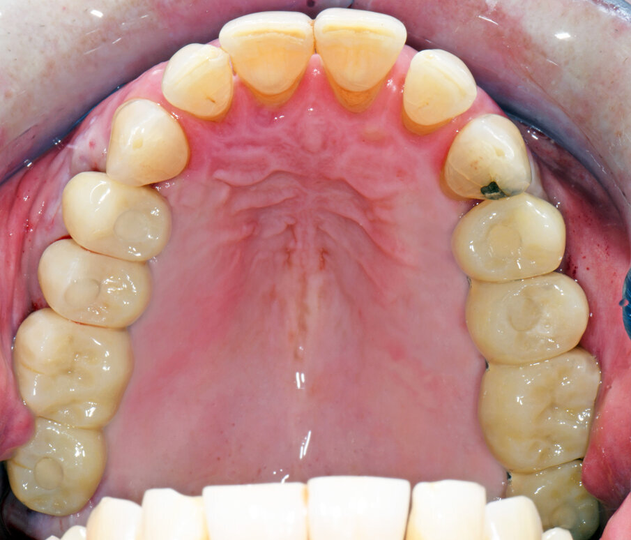 Obr. 10: Stav po šesti měsících hojení s provizorními náhradami.