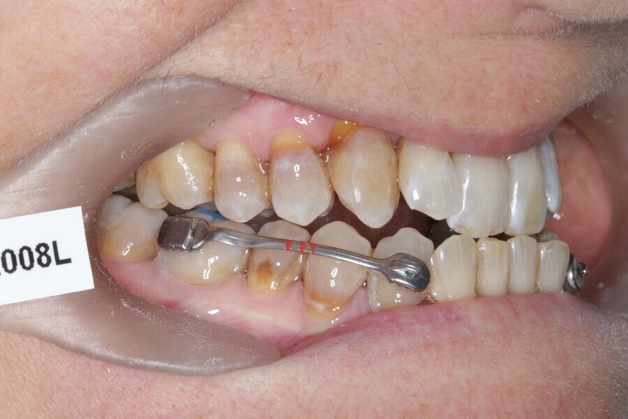 Fig. 31: Placement of the Carriere Motion 3D Class III appliance.