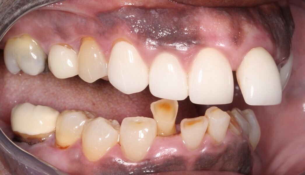 Fig. 6: Right lateral view showing multiple aesthetic and functional deficits.