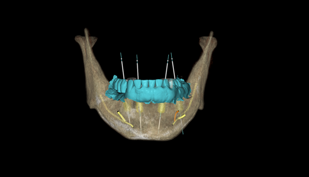 Fig. 3b: Virtual treatment planning showing conventional implants supporting an FP 3 prosthesis in the mandible.