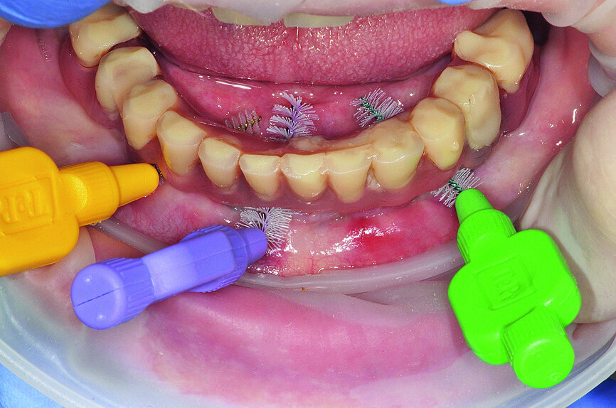 Fig. 4c: Peri-implant home care with a) AirFloss (Philips), b) X-Floss (ROEN) and c) interdental brush (TePe).