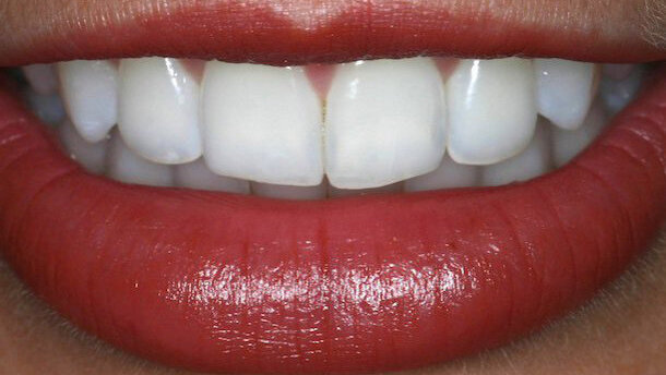 La eficacia de la técnica asociada en el aclaramiento dental