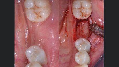 Risoluzione di una atrofia orizzontale